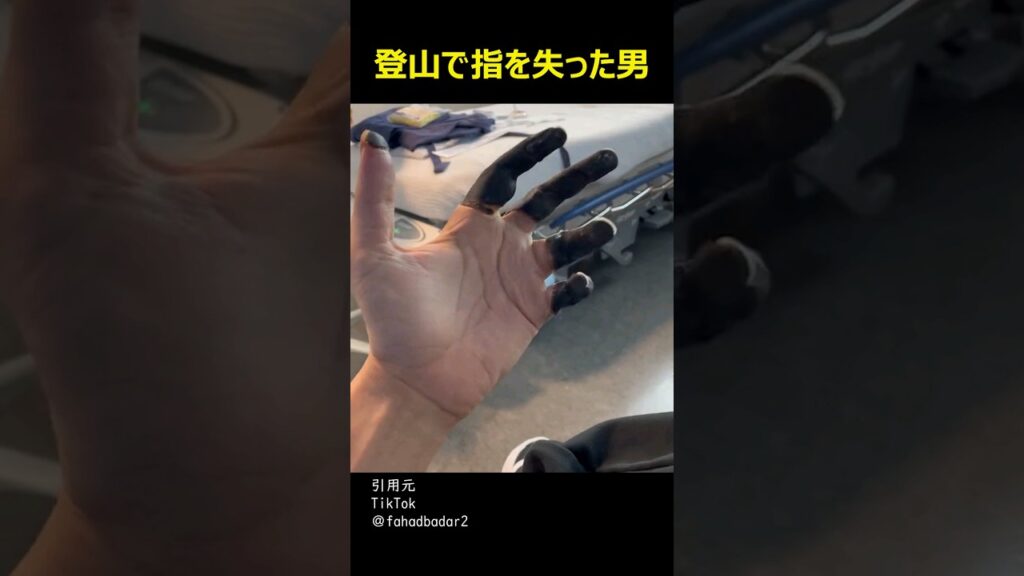 登山で指を失った男